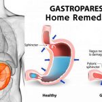 Memahami Istilah Gastroparesis dalam Dunia Medis